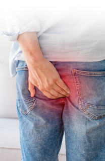 Hemorrhoids Image